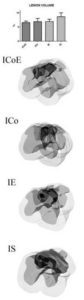 Lesion Volume Analysis