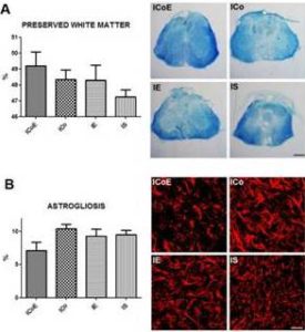 White Matter Sparing and Astrogliosis