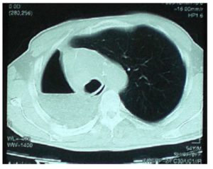 Postoperative control Thorax CT