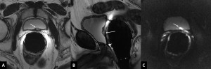 The T2-weighted sequence in the transverse (A) and sagittal (B) planes shows a hyperintense nodule in the posterior wall of the bladder (white arrow).