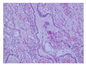 Lung, sheep; chronic bronchopneumonia