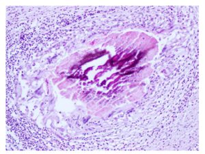 Tracheobronchial lymph node, sheep; granulomatous lymphadenitis